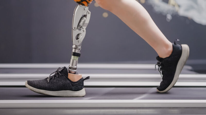 Prosthetic Leg Gate and Walking Physical Therapy